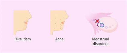 Hyperandrogenism [ Increased Testosterone In Women]