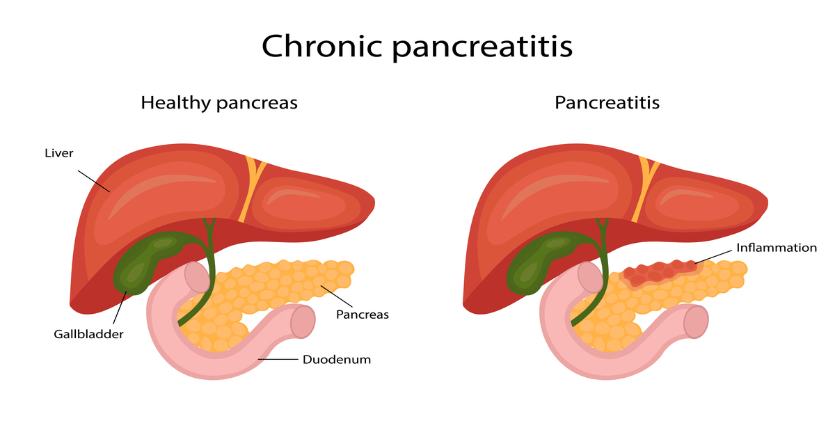 Pancreatitis