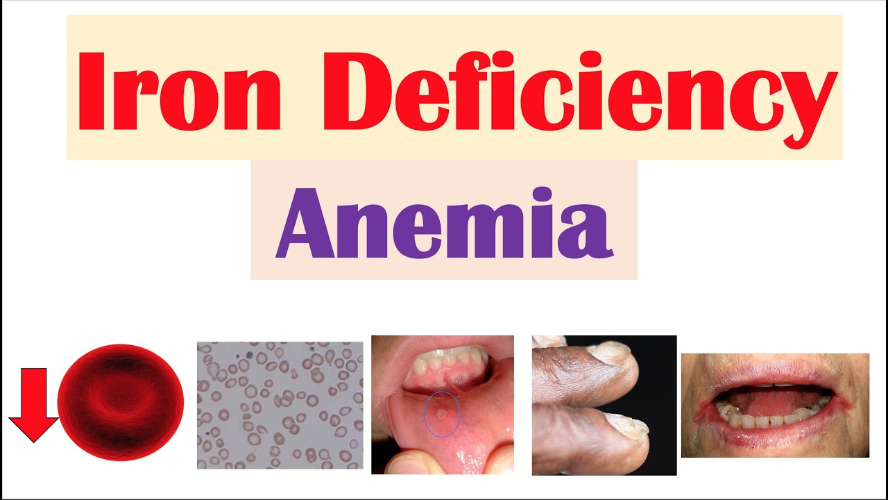 Iron Deficiency