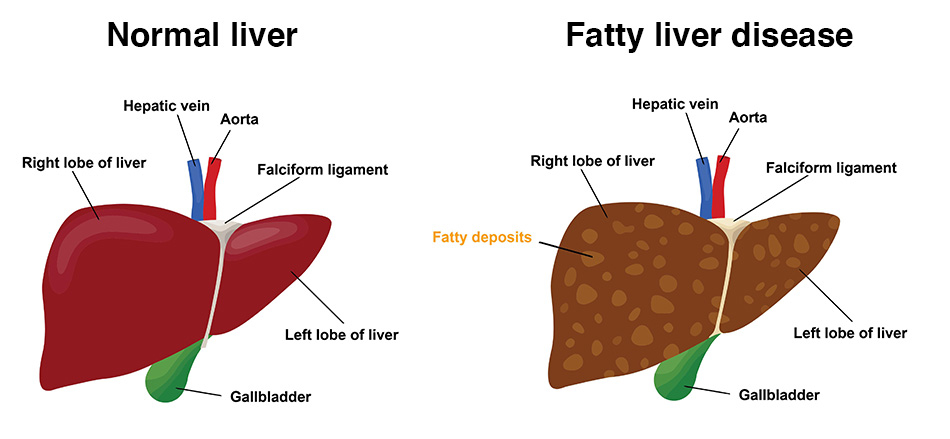 Liver Diseases