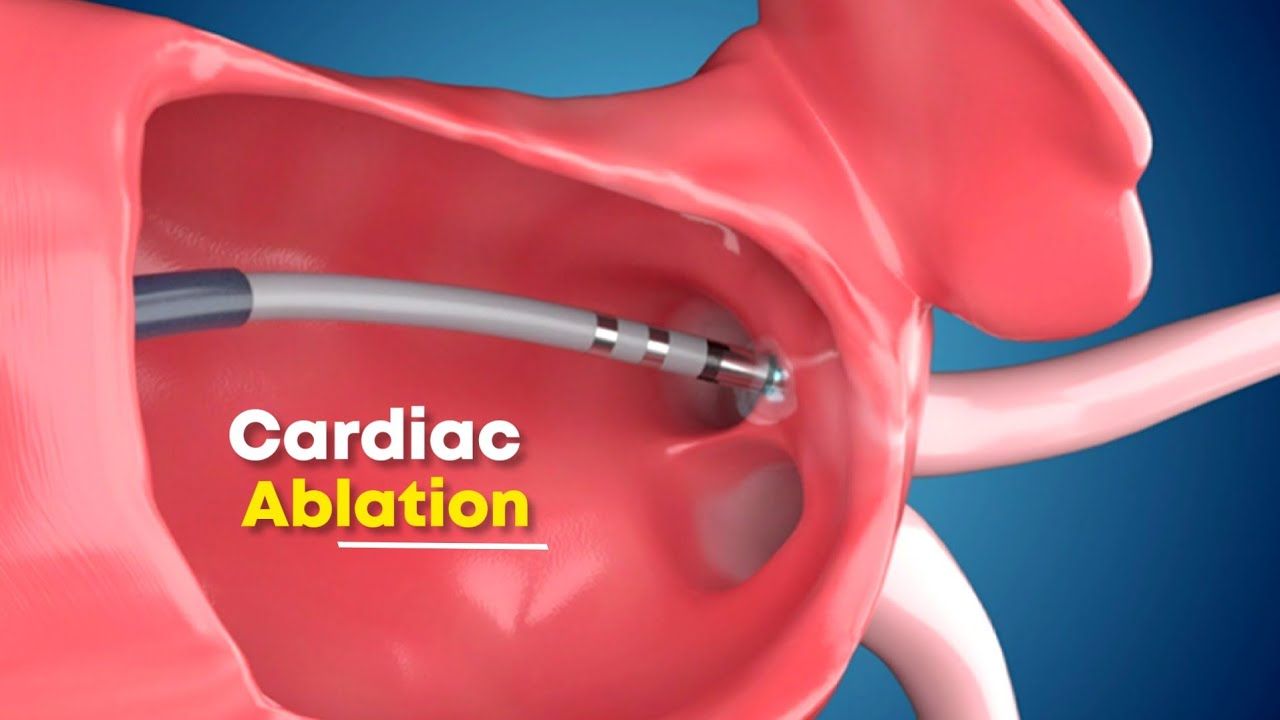 Restoring Heart Health: The Role Of Cardioversion And Cardiac Ablation
