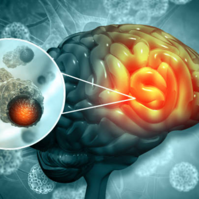 Brain Tumor