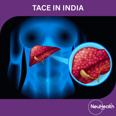 Transarterial Chemoembolization (TACE)