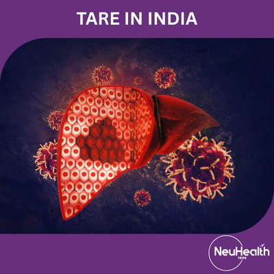 Transarterial Radioembolization (TARE)