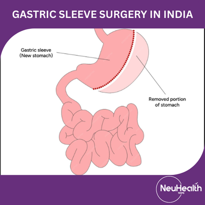 Gastric Sleeve Surgery