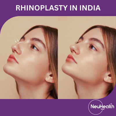 Rhinoplasty