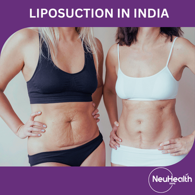 Liposuction
