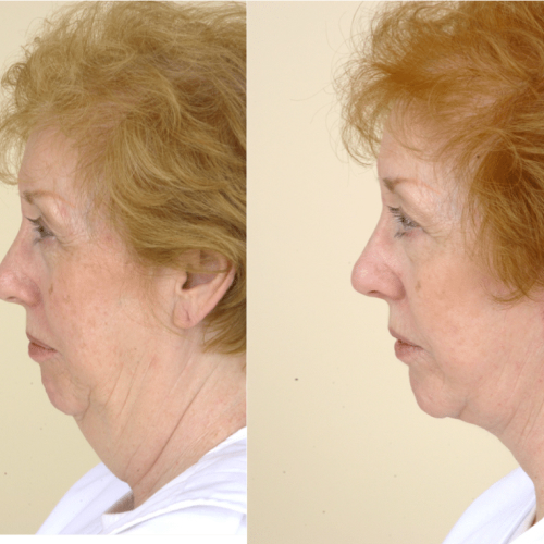 Neck Lift